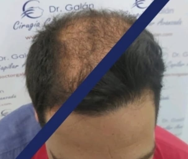 antes y después clínica capilar Málaga